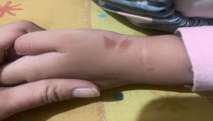 Sadis, Bocah Usia 4 tahun di Bekasi Diduga Disiram Air Panas Oleh Kepala Sekolah